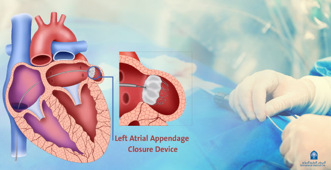 Left atrial appendage device closure in a private hospital in the Kingdom